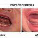Baby Frenectomy Aftercare: A Smooth Recovery Guide | Baby Care 101: Essential Tips for Happy, Healthy Babies