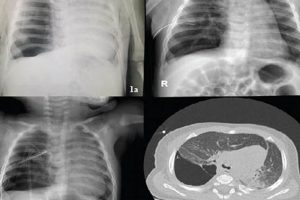 Neonatal Air Leak: Pneumothorax in Newborn Babies Guide Baby Care 101: Essential Tips for Happy, Healthy Babies Neonatal Air Leak: Pneumothorax in Newborn Babies Guide | Baby Care 101: Essential Tips for Happy, Healthy Babies