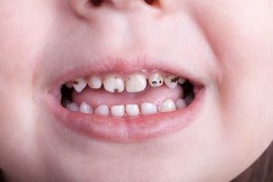 Prevent Baby Bottle Mouth: Tips & Treatment Baby Care 101: Essential Tips for Happy, Healthy Babies Prevent Baby Bottle Mouth: Tips & Treatment | Baby Care 101: Essential Tips for Happy, Healthy Babies