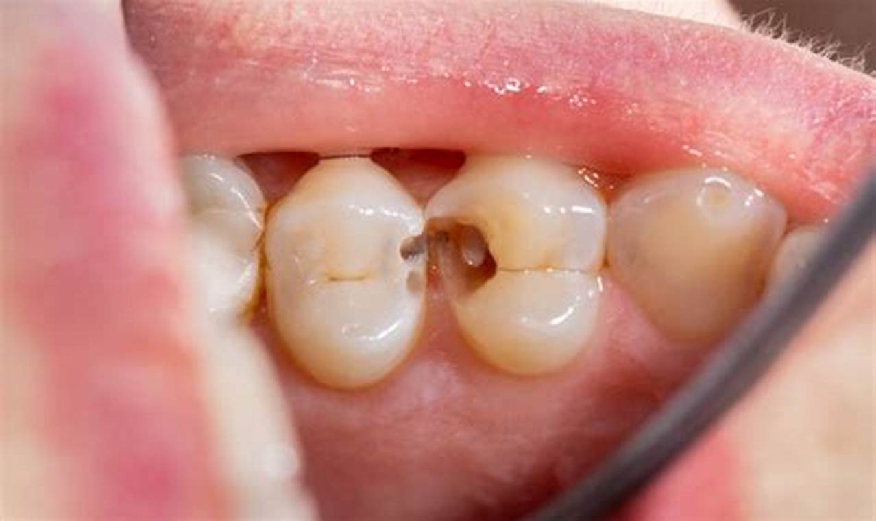 Baby Teeth Saver: Alternatives to Filling Cavities Baby Care 101: Essential Tips for Happy, Healthy Babies Baby Teeth Saver: Alternatives to Filling Cavities | Baby Care 101: Essential Tips for Happy, Healthy Babies