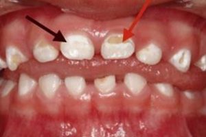 Help! White Spots on Baby Teeth: Causes & Care Tips Baby Care 101: Essential Tips for Happy, Healthy Babies Help! White Spots on Baby Teeth: Causes & Care Tips | Baby Care 101: Essential Tips for Happy, Healthy Babies