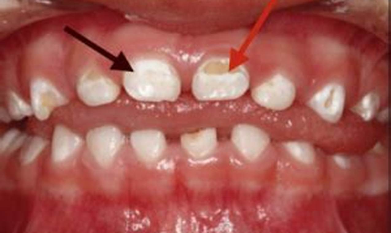 Help! White Spots on Baby Teeth: Causes & Care Tips Baby Care 101: Essential Tips for Happy, Healthy Babies Help! White Spots on Baby Teeth: Causes & Care Tips | Baby Care 101: Essential Tips for Happy, Healthy Babies