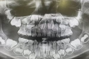Early Baby Teeth X-Ray: Guide & Safety Tips Baby Care 101: Essential Tips for Happy, Healthy Babies Early Baby Teeth X-Ray: Guide & Safety Tips | Baby Care 101: Essential Tips for Happy, Healthy Babies