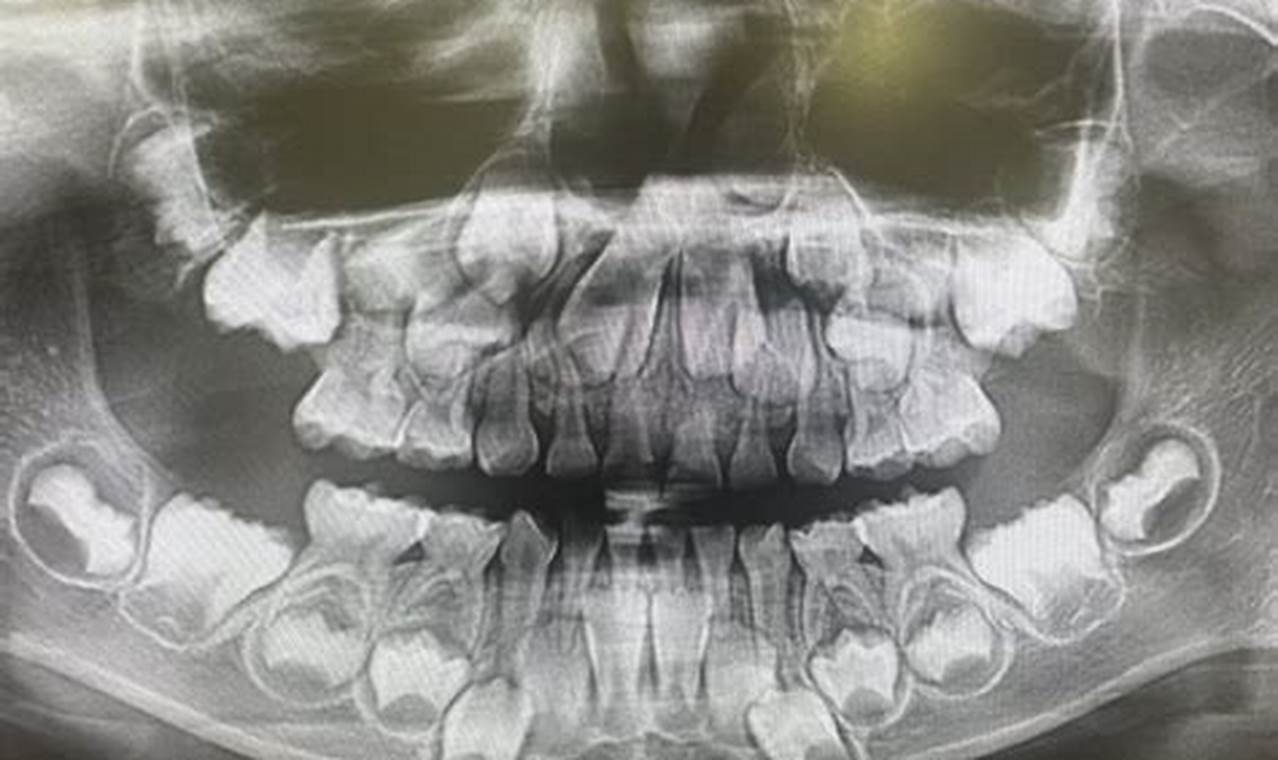 Early Baby Teeth X-Ray: Guide & Safety Tips Baby Care 101: Essential Tips for Happy, Healthy Babies Early Baby Teeth X-Ray: Guide & Safety Tips | Baby Care 101: Essential Tips for Happy, Healthy Babies