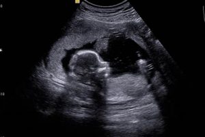 See Baby Ultrasound Pictures Now: Early Glimpse! | Baby Care 101: Essential Tips for Happy, Healthy Babies