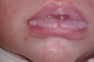 Bottle Woes: Treating Blisters on Baby's Lips (Bottle-Fed) | Baby Care 101: Essential Tips for Happy, Healthy Babies