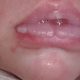 Bottle Woes: Treating Blisters on Baby's Lips (Bottle-Fed) | Baby Care 101: Essential Tips for Happy, Healthy Babies