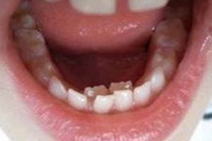 Help! Adult Teeth Behind Baby Teeth: What's Next? | Baby Care 101: Essential Tips for Happy, Healthy Babies