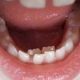 Help! Adult Teeth Behind Baby Teeth: What's Next? | Baby Care 101: Essential Tips for Happy, Healthy Babies