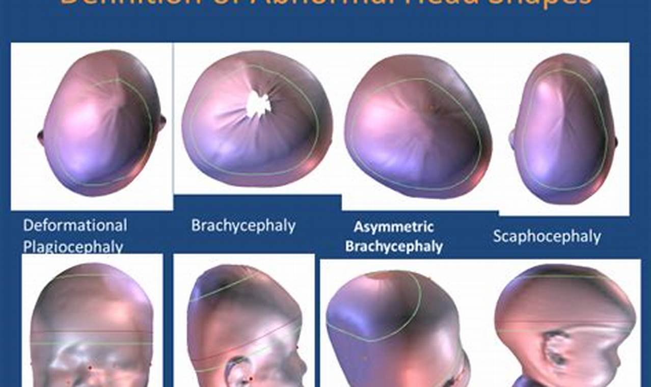Baby Head Shapes: Abnormal Pics, Causes & Care Tips | Baby Care 101: Essential Tips for Happy, Healthy Babies